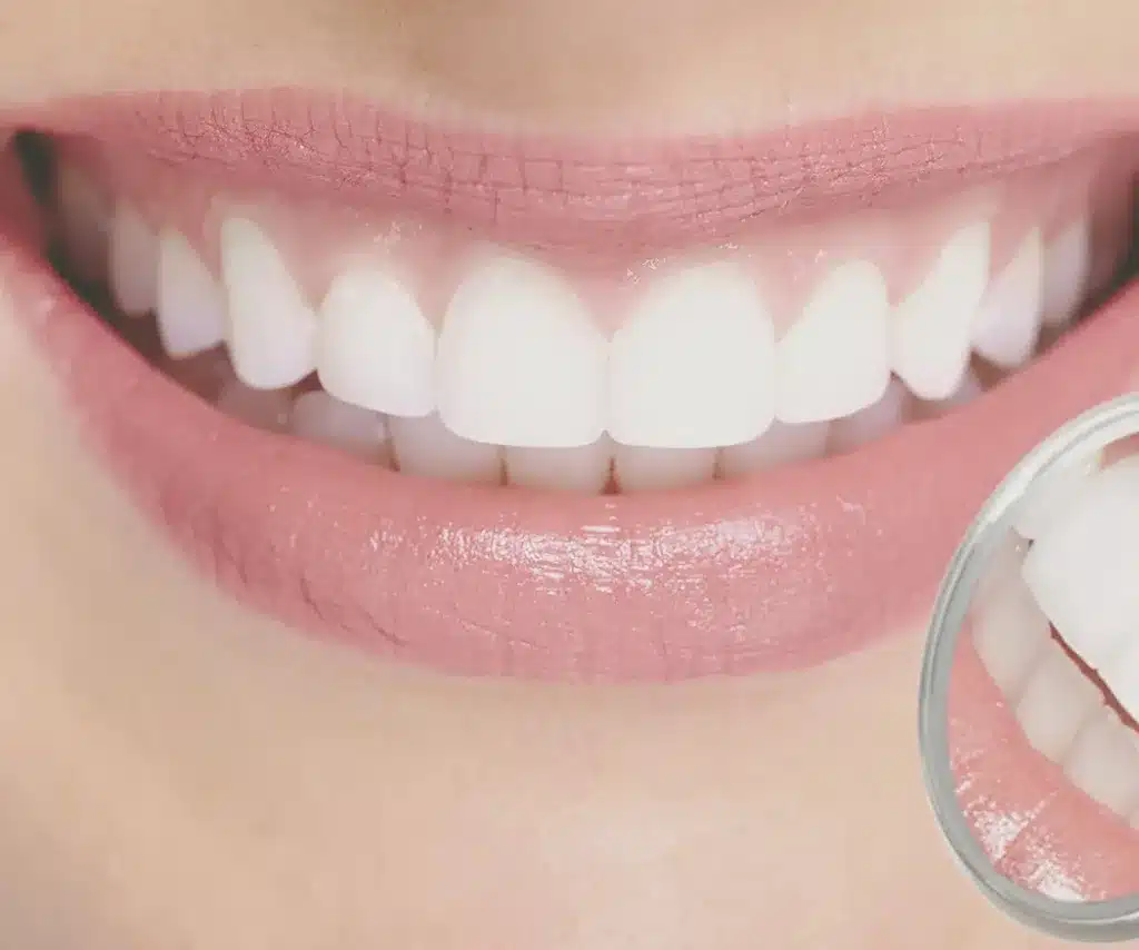 Final Thoughts on Teeth Whitening for Sensitive Teeth